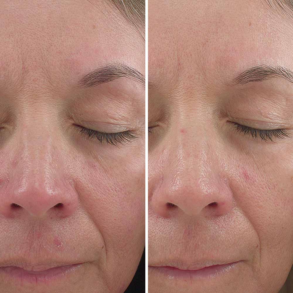 Jan Marini Skin Peel Cheshire
