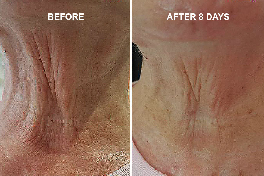 Plasma Pen - Neck Tightening