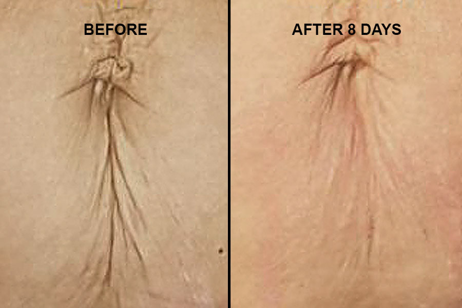 Plasma Pen - Stretch Mark Reduction
